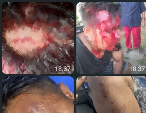 Foto: Dua Luka Sobek dan Memar dua Anggota Polri (Doc: Tim)